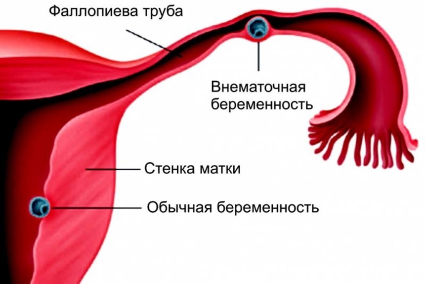 анализ крови на хгч